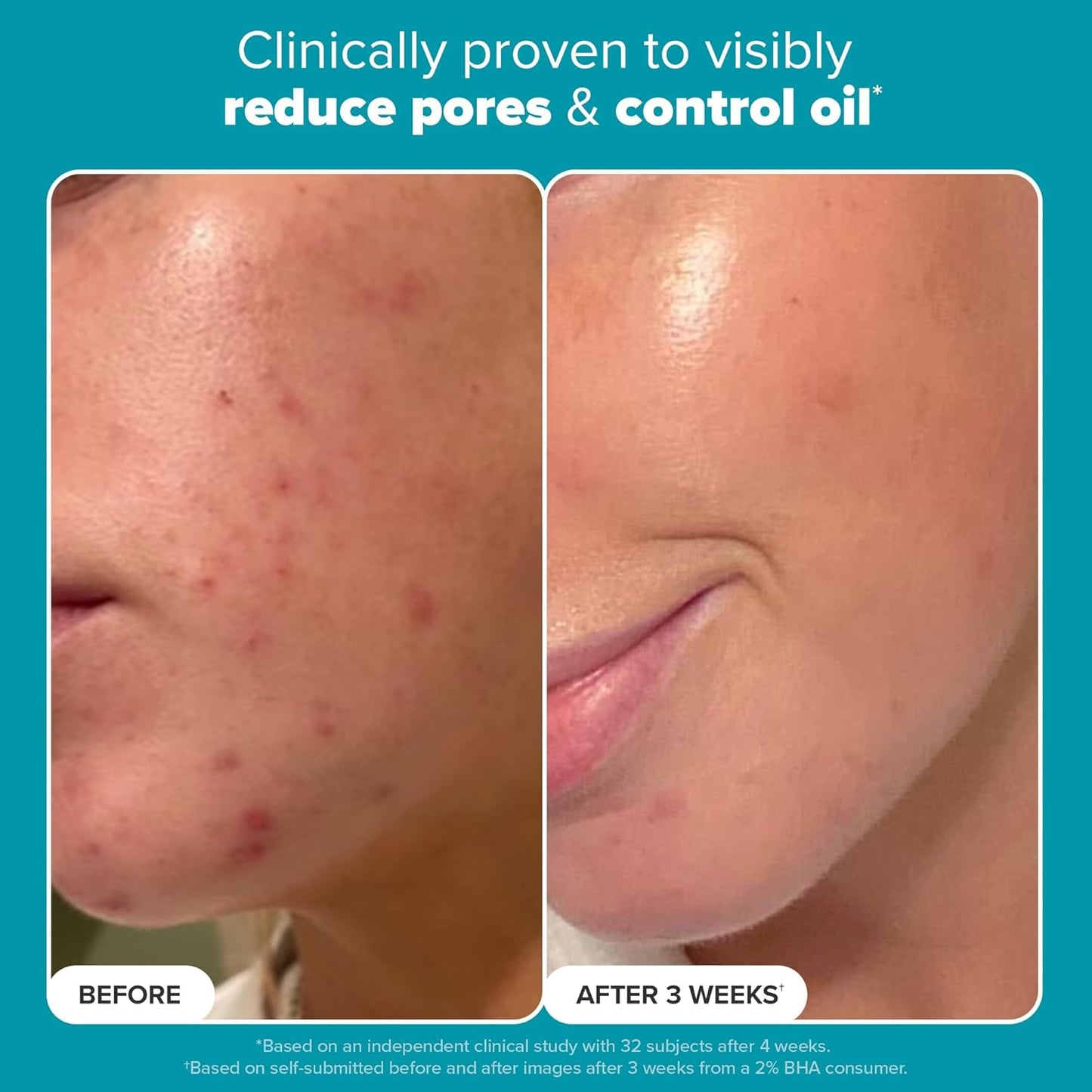 Skin Perfecting 2% BHA Liquid Salicylic Acid Exfoliant, Gentle Facial Exfoliator for Blackheads, Large Pores, Wrinkles & Fine Lines, Travel Size, 30 Ml Bottle
